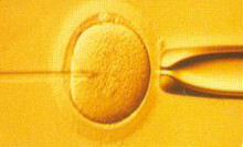 Injektion in das Zytoplasma einer weiblichen Eizelle