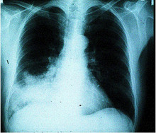 Auf dem Röntgenbild eines Pneumonie-Patienten sind deutliche Schatten sichtbar
