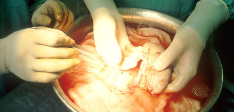 Vor der Transplantation wird die Niere in Eiswasser gelegt, gesäubert und gespült.